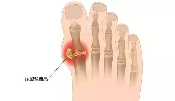 导致痛风发作的原因有哪些