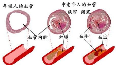 是什么原因导致血管寿命减少-陕西千秋玄鹿治疗仪