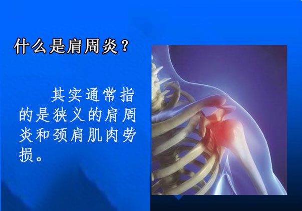 长时间坐电脑前工作肩膀疼痛怎么办？