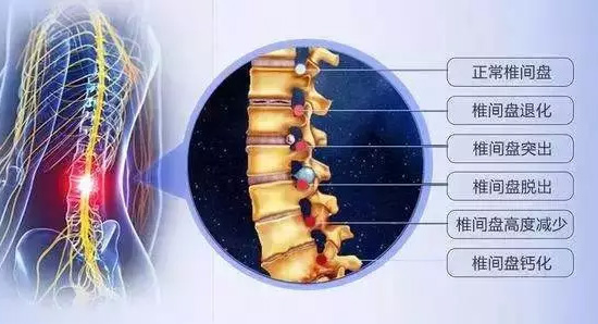 腰痛是可能是腰椎间盘突出症