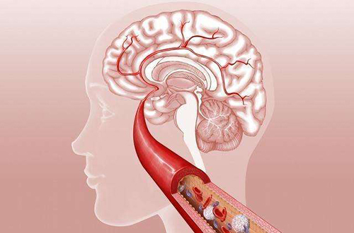 引发脑梗的因素有哪些