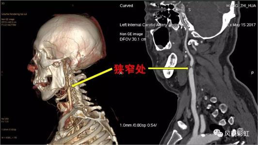 颈椎病都是“积”出来的，4个伤颈的行为，别总是做